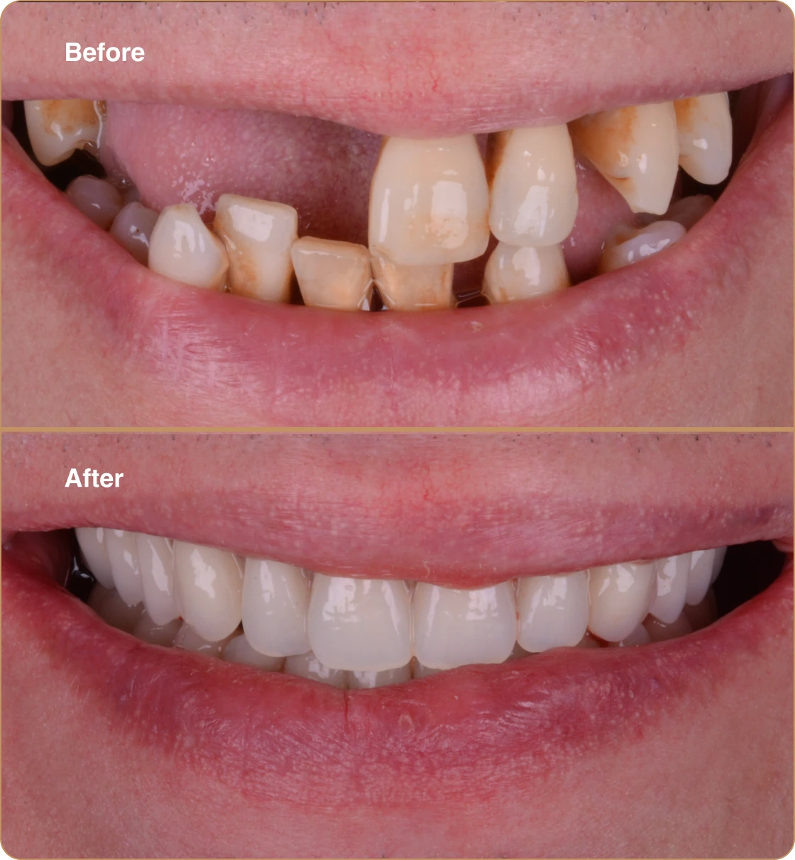 implant-supported-dentures