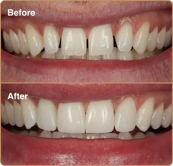 Before-and-after