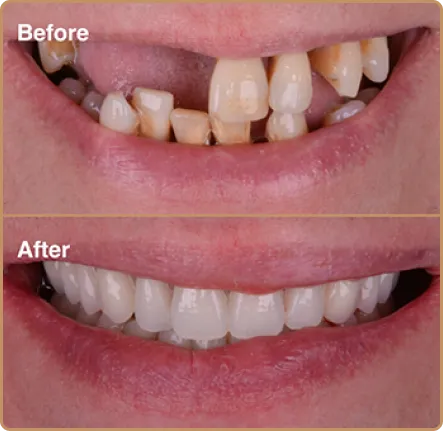 Dental-Implants-1