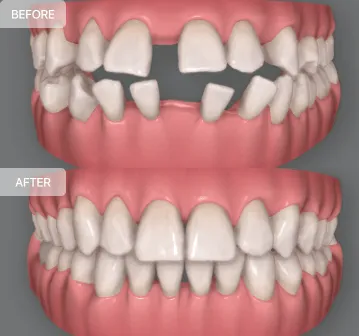 Gappt-teeth-image
