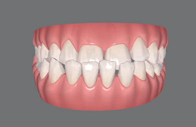 Invisalign-Full