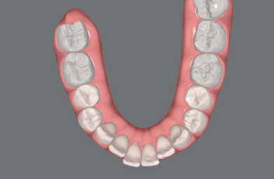 Invisalign-Moderate