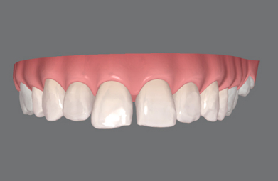 Invisalign-lite