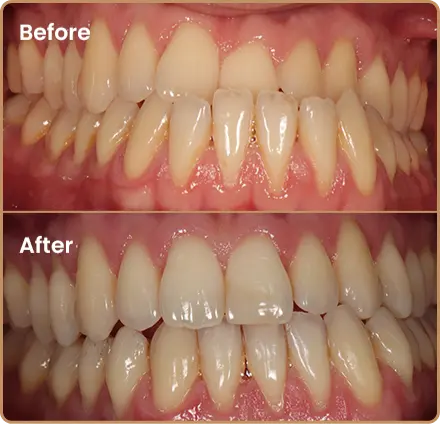 Invisalign-underbite