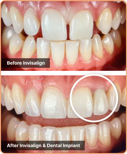 Invisalign-with-dental-implants-new