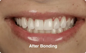 after-bonding after bonding - composite bonding