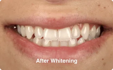 after-whitening after whitening - composite bonding