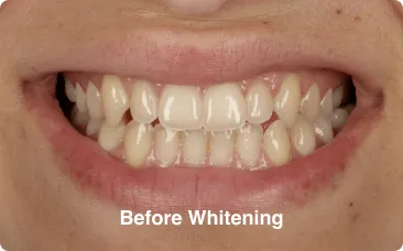 before-whitening before whitening - composite bonding