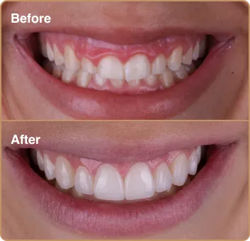 before_after1