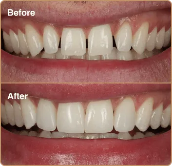 composite-before-after-3 before and after results - composite bonding