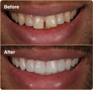 before and after results - composite bonding
