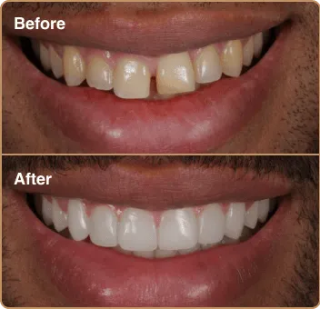 composite-before-after-5 before and after results - composite bonding
