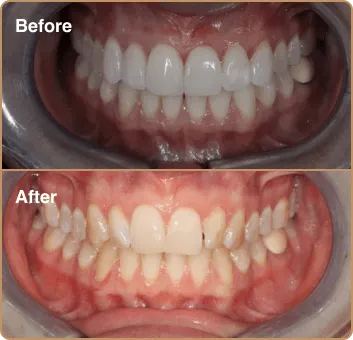 composite-before-after-6 before and after results - composite bonding