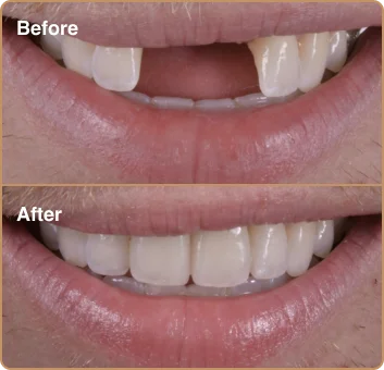 dental-treatment-before-after-img-1