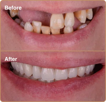 dental-treatment-before-after-img-3