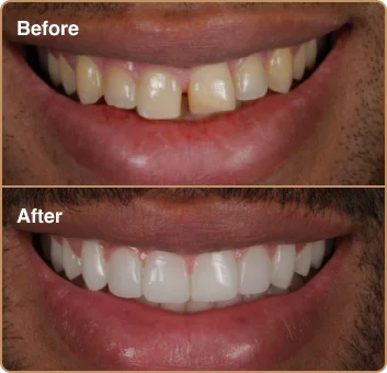 dental-treatment-before-after-img-8