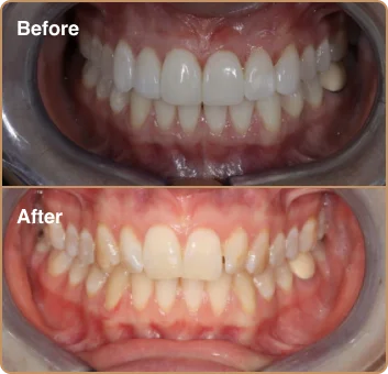 dental-treatment-before-after-img-9