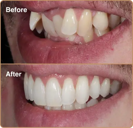 front-teeth