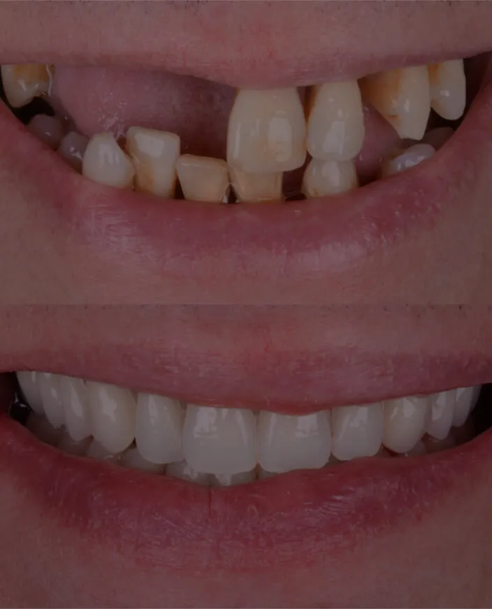 fulll_arch_dental_implants