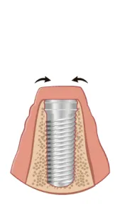 implant-process-2