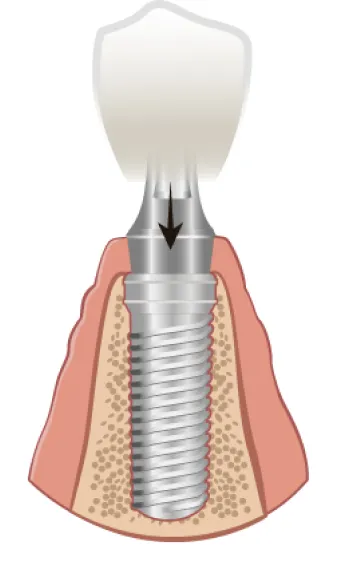 implant-process-4