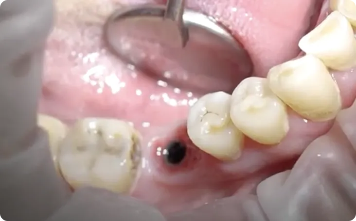 implant