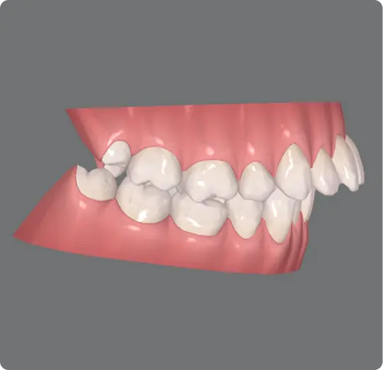 over-bite