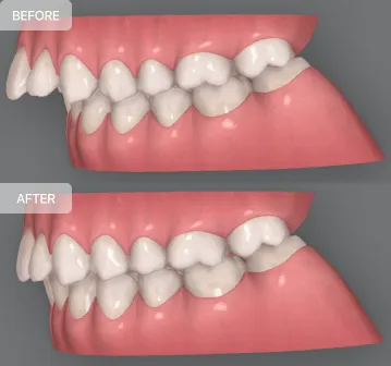 overbite-image