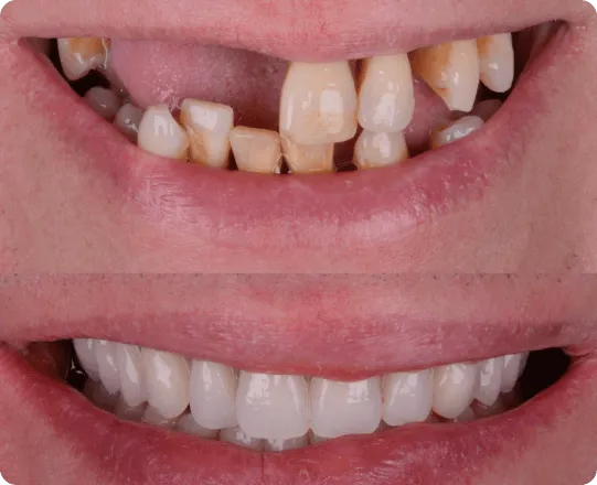 overview_mulitple_dental_implants