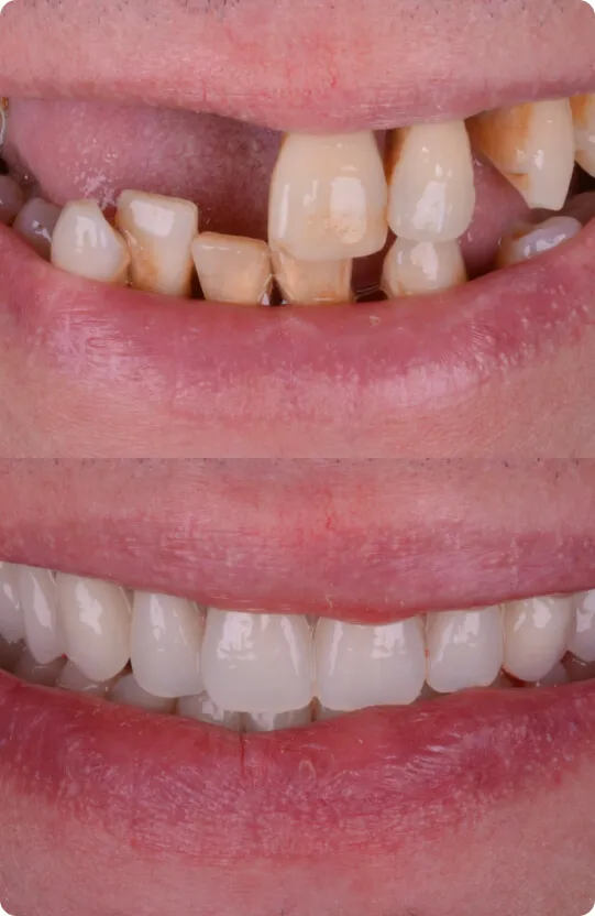 single_tooh_implant