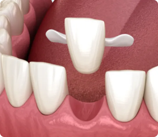 types-of-dental-bridges