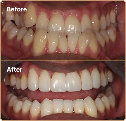 unb-01 Invisalign Manchester