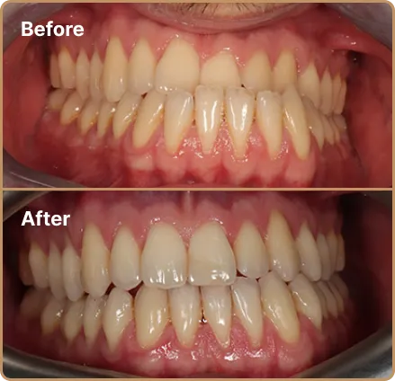 unb-03 Dental Implants Manchester