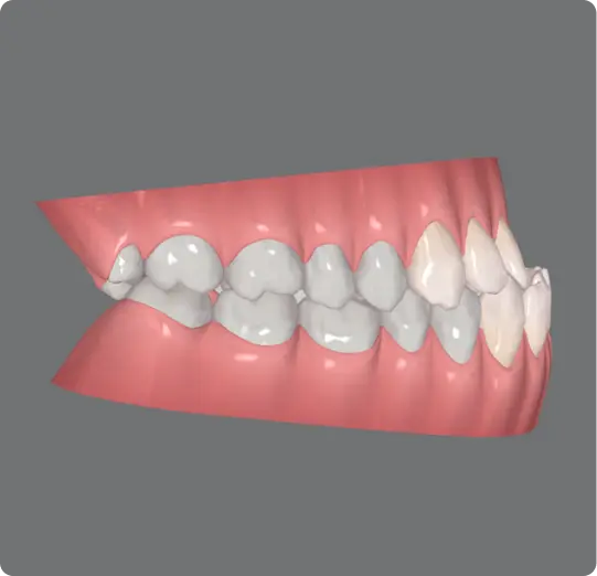 under-bite