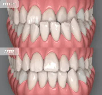 underbite-image