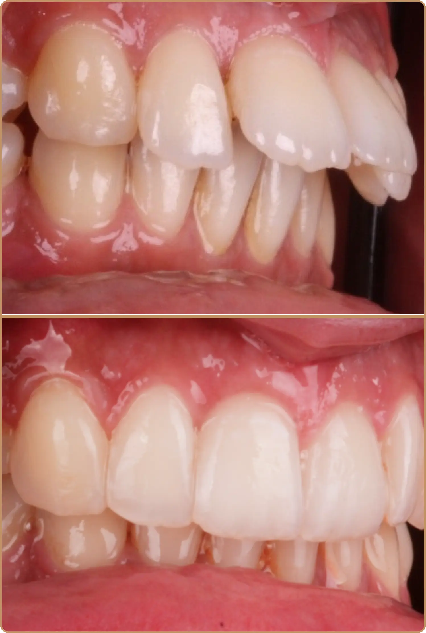 why-do-i-have-an-overbite