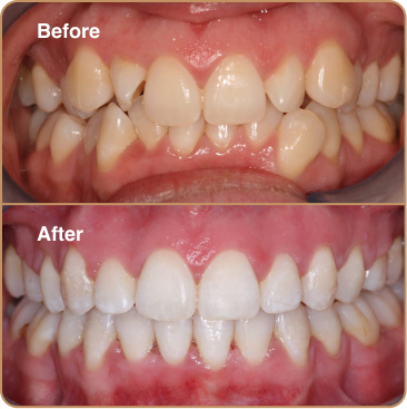 Before and After 1A