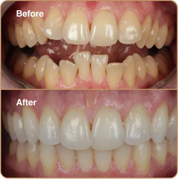 Before and After 1B