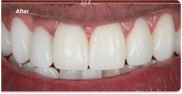 worn-teeth-after