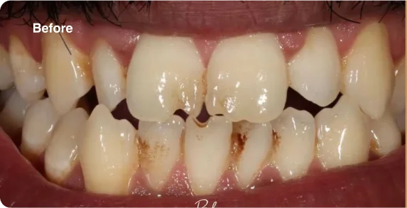 worn-teeth-before