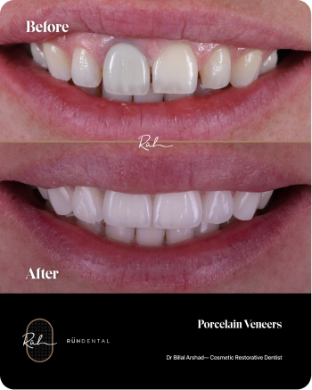 porcelain-veneers-1