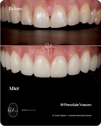 porcelain-veneers-2