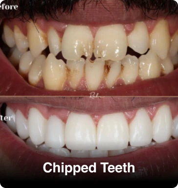 Chipped Teeth