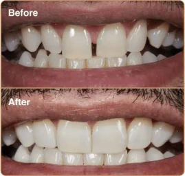 Composite Bonding Manchester Composite Bonding Manchester