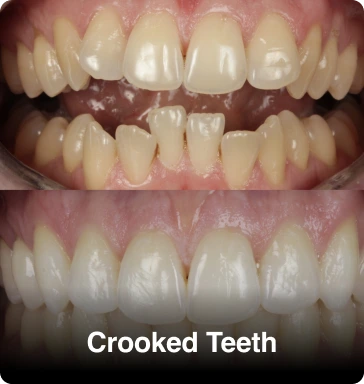 Crooked Teeth