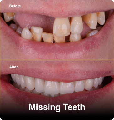 Missing teeth