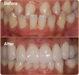 Porcelain Veneers Manchester Porcelain Veneers Manchester