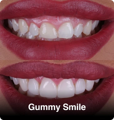 Same-Day-Gummy-Smile