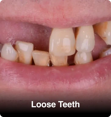 Same-Day-Loose-Teeth