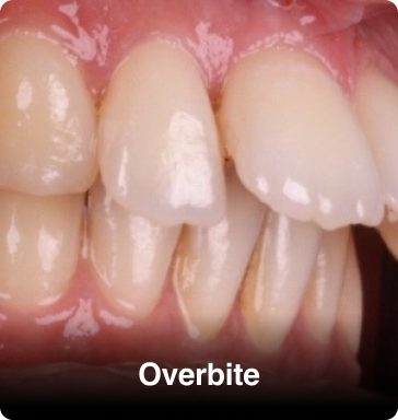 Same-Day-Overbite